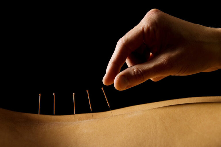 Acupunctura: O soluție naturală pentru durerile tale de spate